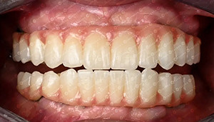 najnowsza sprawa firmy na temat Przypadek klienta. 4D Zirconia Block.