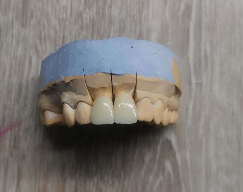Odkryj wszechstronność krążków z tlenku cyrkonu Yucera ST color do koron i mostów dentystycznych